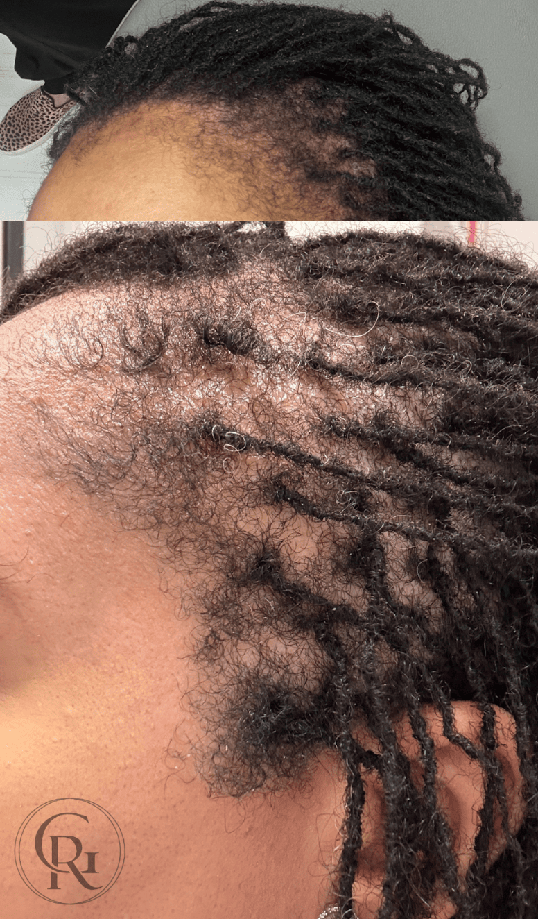 Dreadlocks hairstyle with natural hair texture and some loose curls.